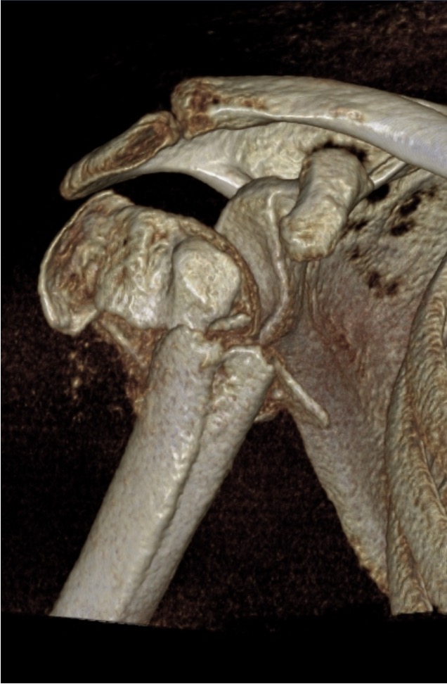 Schouderkop fractuur